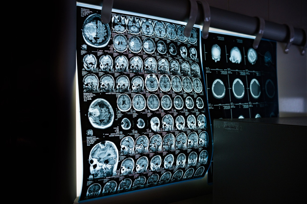 MRI scanning av hjärnan